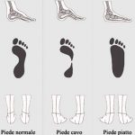 Difetti dei piedi e postura