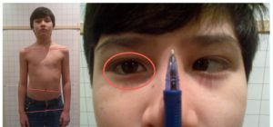 Correlazione tra difetti agli occhi e postura non corretta